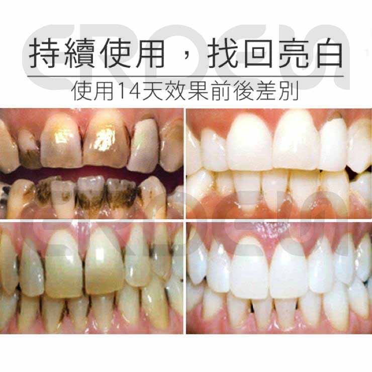 歯を白く保つための継続的な使用